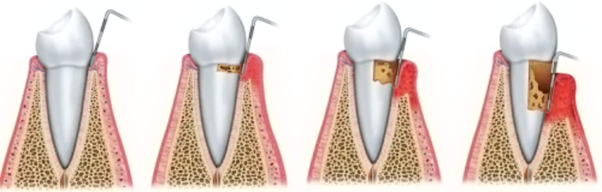 periodontal